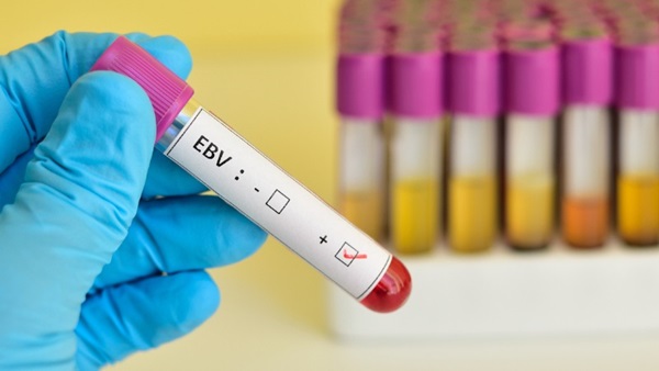 syndrome d'Epstein-Barr